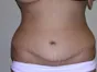 AB01-tummy-tuck-front-after photo - Lawton Plastic Surgery San Antonio TX