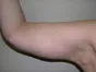BRACH01-arm-lift-side right-after photo - Lawton Plastic Surgery San Antonio TX