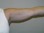 arm01-liposuction-arms-left-before photo - Lawton Plastic Surgery San Antonio TX