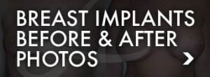 Breast Implants Before & After Photos - Lawton Plastic Surgery San Antonio TX