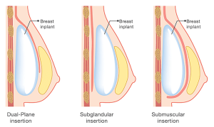 Dual Plan Breast Implants